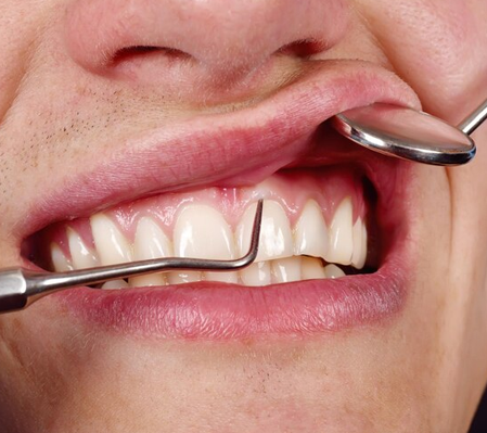 teeth makeover in Fulwood