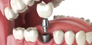 Dental Implants in Preston