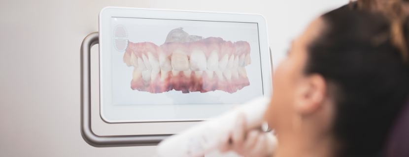 close up of a screen from an Intraoral scanner showing a digital image of a lady's teeth