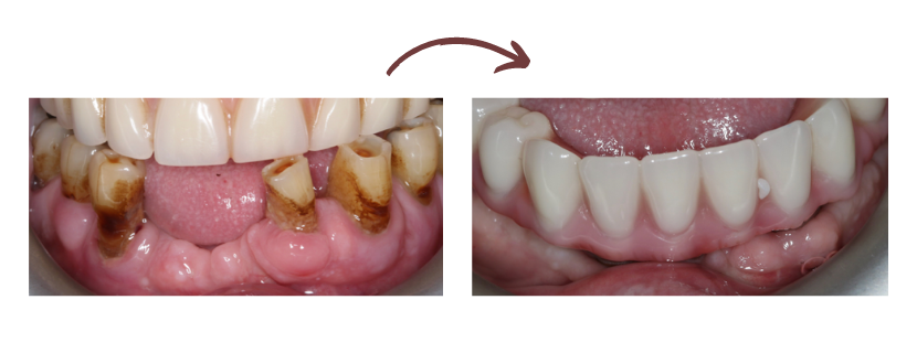Before and after of smile in a day dental implants from lifestyle dental bottom arch of teeth