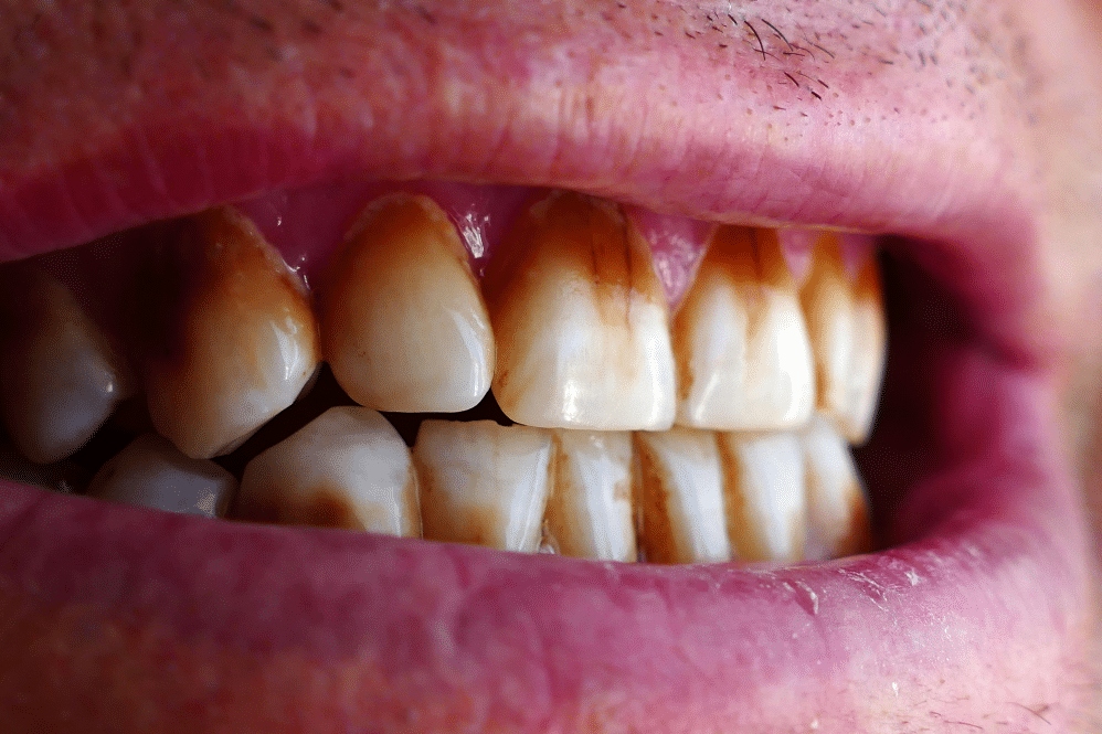 Can a Dentist Tell If You Smoke? Lifestyle Dental in Preston Explains