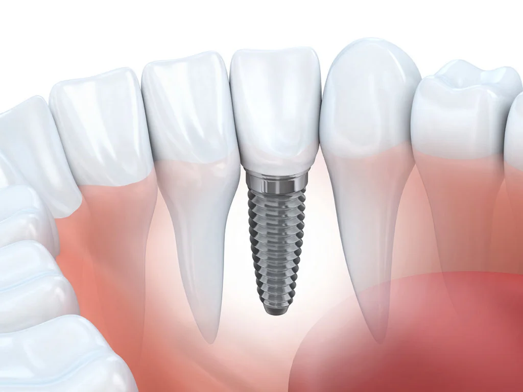 Lancaster implant dentist