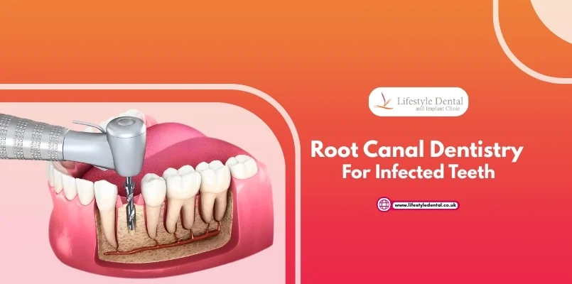 Root Canal Dentistry for Infected Teeth